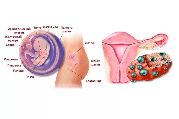 Склерокистоз яичников зачатие. Синдром поликистоза яичников. Беременность с поликистозом яичников. Забеременеть при поликистозе яичников.