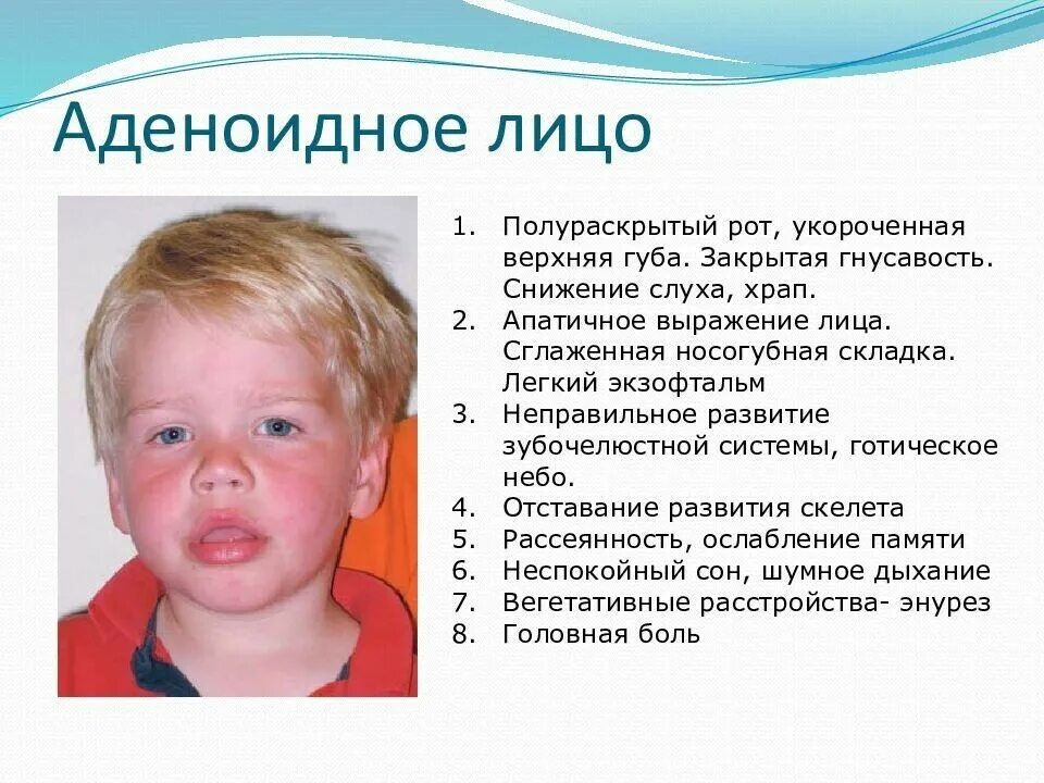 Сглажена носогубная складка. Аденоидный Тип лица у детей. Аденоидное выражение лица. Формирование аденоидного типа лица.