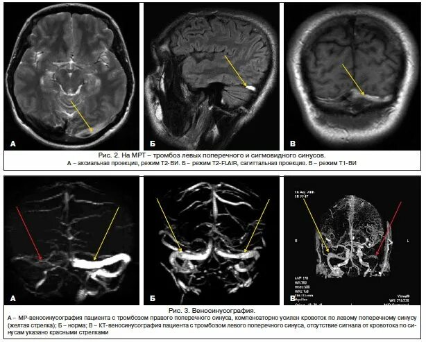 Гипоплазия правого поперечного синуса. Тромбоз поперечного венозного синуса на мрт. Тромбоз сигмовидного синуса на кт. Тромбоз синусов головного мозга мрт. Тромбоз поперечного синуса кт.