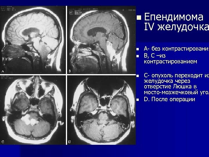 Опухоль 4 желудочка головного мозга. Мостомозжечковый угол анатомия кт. Опухоли желудочков головного мозга кт. Опухоли 4 желудочка головного мозга мрт. Мозжечковая опухоль