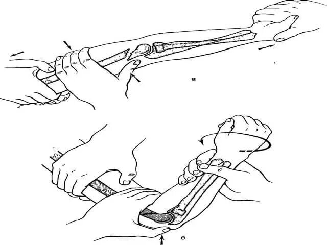 Ручная репозиция при переломе луча в типичном месте. Репозиция перелома лучевой кости. Репозиция отломков при переломе. Репозиция наружной лодыжки. Остеосинтез головки лучевой кости.
