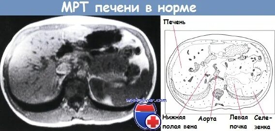 Расшифровка кт печени фото Кт печени с контрастом подготовка