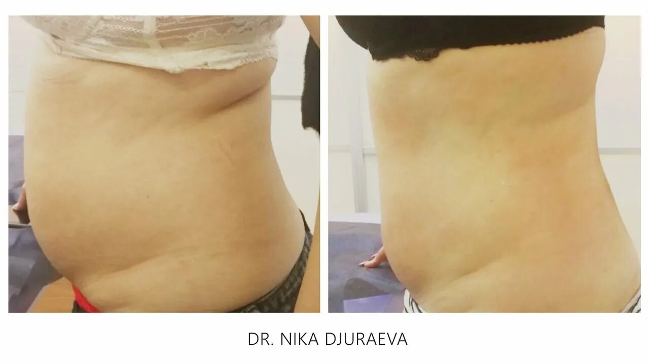 кавитация живота отзывы. кавитация живота отзывы. кавитация живота до и после. прессотерапия живота до и после. лазерная кавитация липолиз.