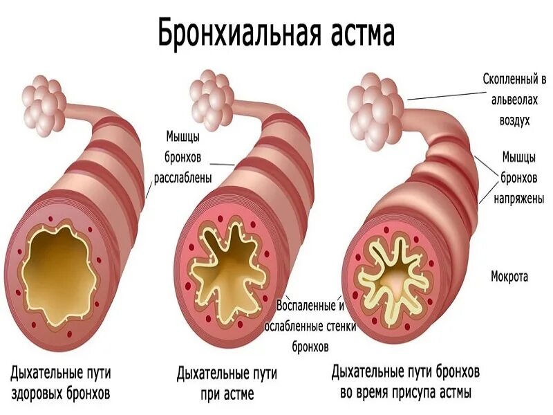 Бронхиальная астма курсовая работа. Воспалительные факторы бронхиальной астмы. этиология бронх астмы. бронхиальная астма патологическая анатомия. причины развития бронхиальной астмы у детей.