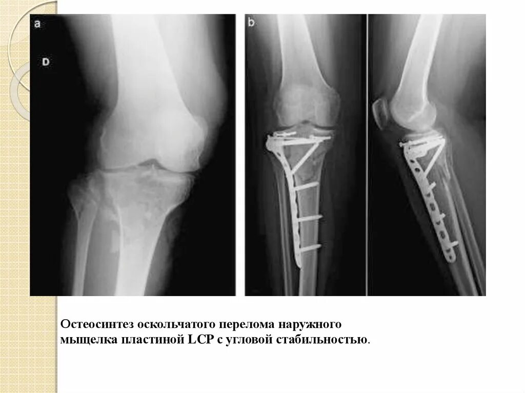 Внутрисуставной перелом медиального мыщелка большеберцовой кости. Консолидирующийся перелом наружного мыщелка большеберцовой кости. Остеосинтез переломов мыщелков большеберцовой кости. Остеосинтез мыщелков плечевой.