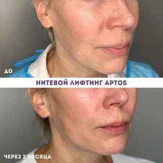 Птоз верхнего века мкб