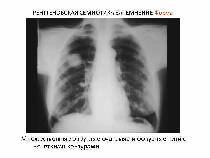 Округлое затемнение. Фокусная тень в легких на рентгенограмме. Множественные очаговые тени в легких. Очаговые тени с нечеткими контурами. Очаговое затемнение в легком.