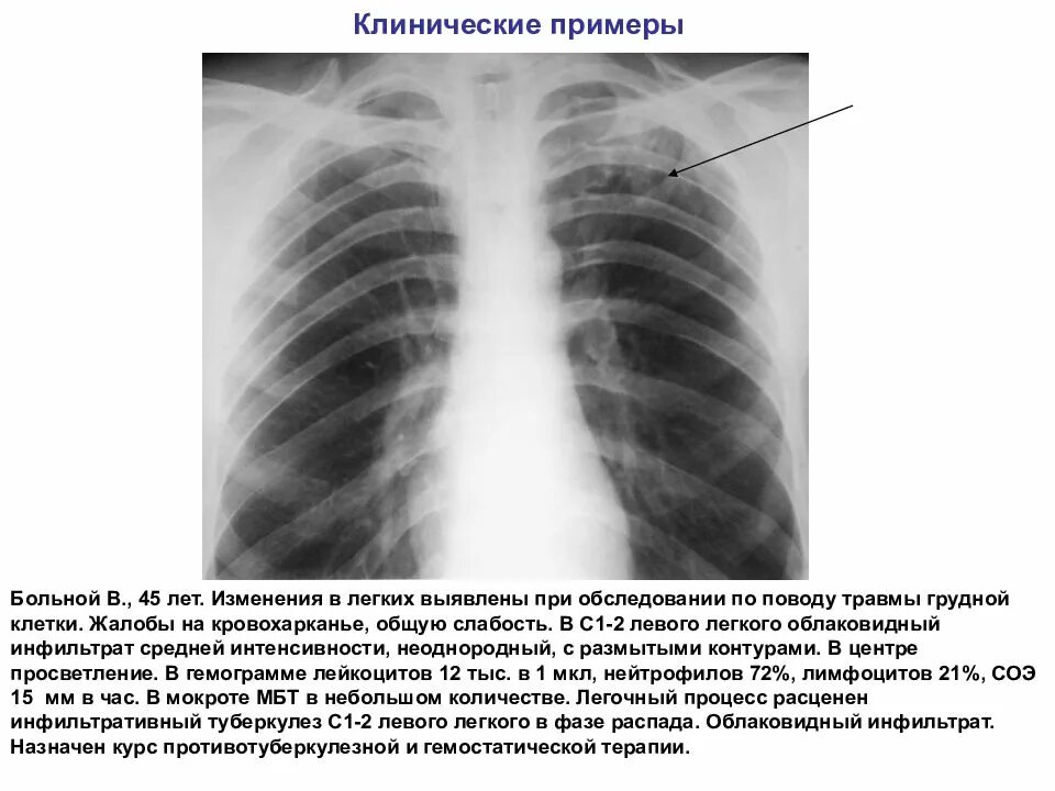 Какие изменения в легких. Инфильтративный туберкулез легких с 1. инфильтративный туберкулёз лёгких рентген. инфильтративный туберкулез s1-2 левого легкого. инфильтративный туберкулез левого легкого 1 мбт.