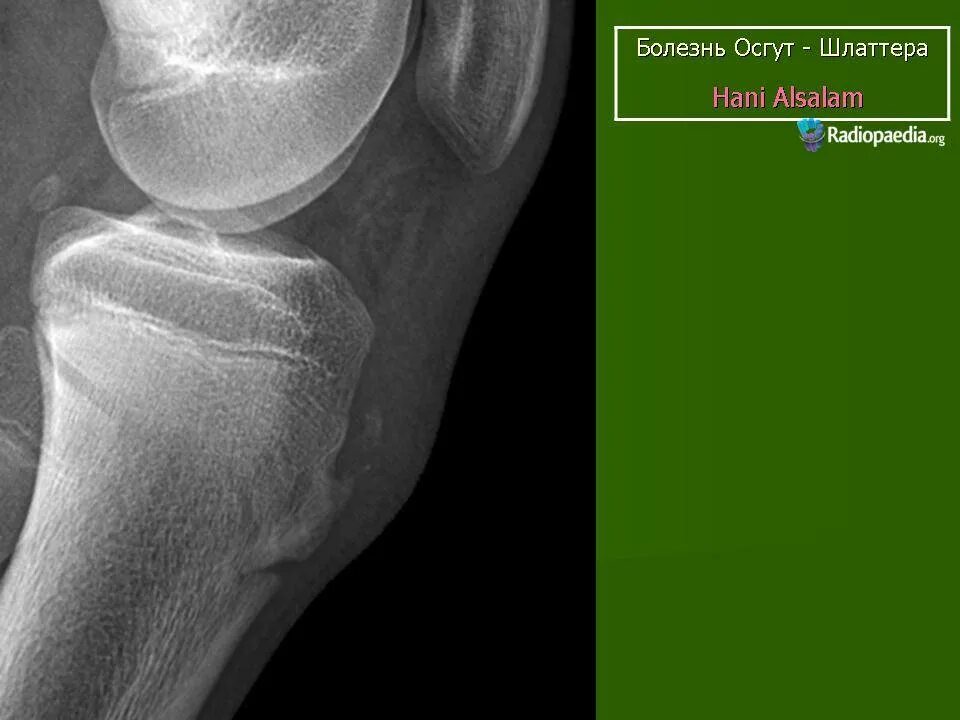 Шляттера мкб 10. Болезнь Шляттера коленного сустава. Осгуд Шляттера бандаж. Шляттера Осгуда операция. Осгуда Шляттера снимки.