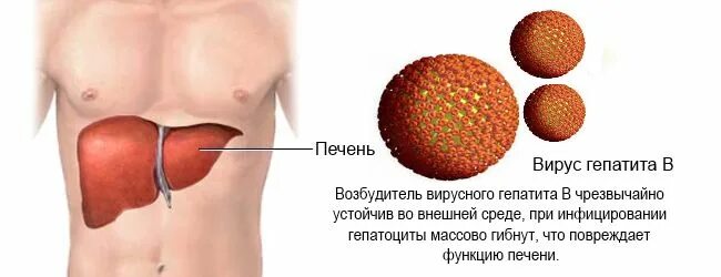 Заболевание печени гепатиты. Вирусный гепатит печень. Печень при вирусном гепатите.