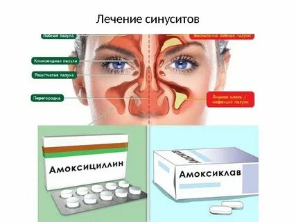 Вирусный гайморит