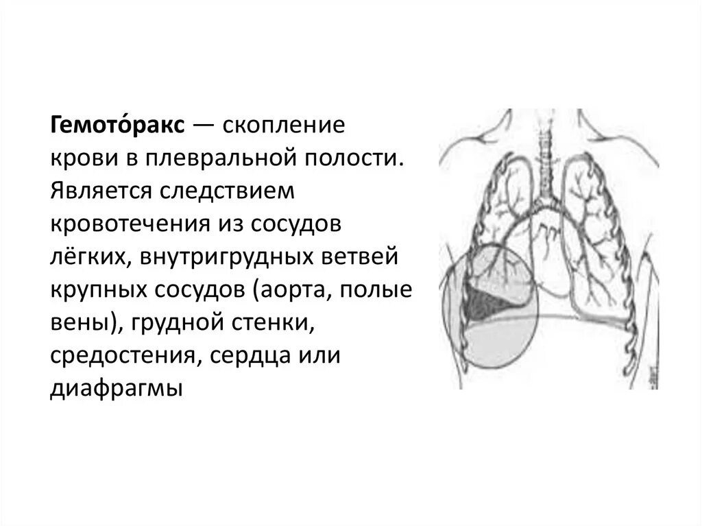 Гематома плевральной полости. Наличие крови в синусах плевральной полости. Гемоторакс это скопление в плевральной полости.