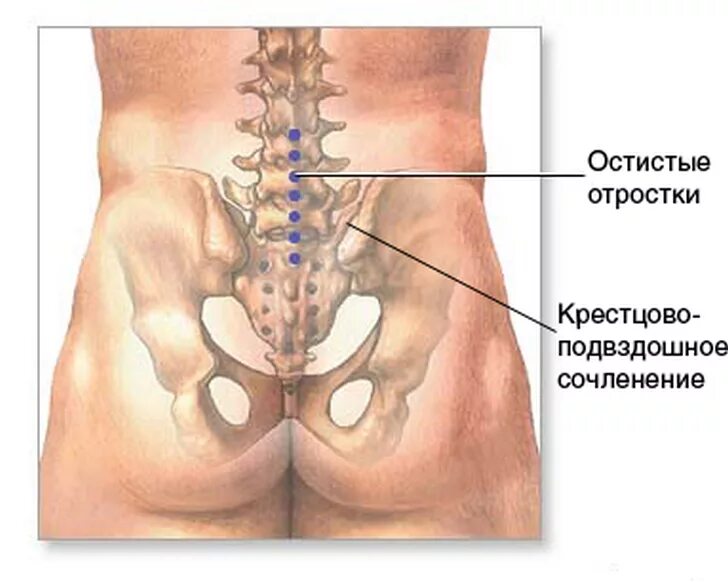 Доступы к крестцово подвздошному сочленению. Крестцово-подвздошное сочленение. Сакроилеит крестцово-подвздошного сустава. Анатомия крестцово-подвздошного сочленения. Сакроилеит крестцово-подвздошного сочленения степени.