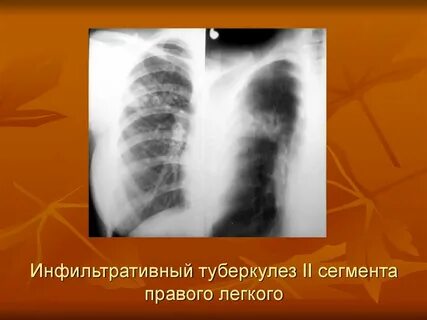 Инфильтрация средней доли легких