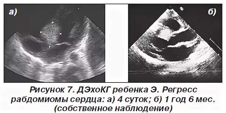 Рабдомиома сердца. Рабдомиома сердца у детей. Рабдомиомы сердца у новорожденных. Рабдомиома сердца Эхо кг.