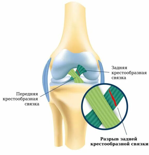 Крестообразные связки коленного мениска. ПКС (передняя крестообразная связка). Растяжение крестообразной связки коленного сустава. Разрыв крестообразной связки.