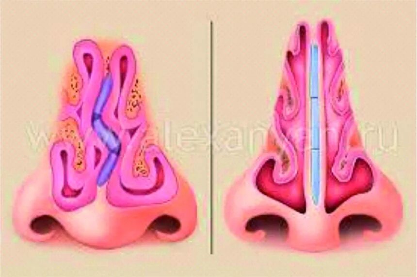 девиация носовой перегородки влево. анатомия искривлённой носовой перегородки. искривление носовой перегородки операция схема. изогнутая перегородка носа. искривление перегородки с костным гребнем.