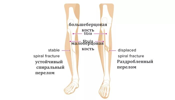 Болит нога большеберцовая кость. Боль в малоберцовой кости.