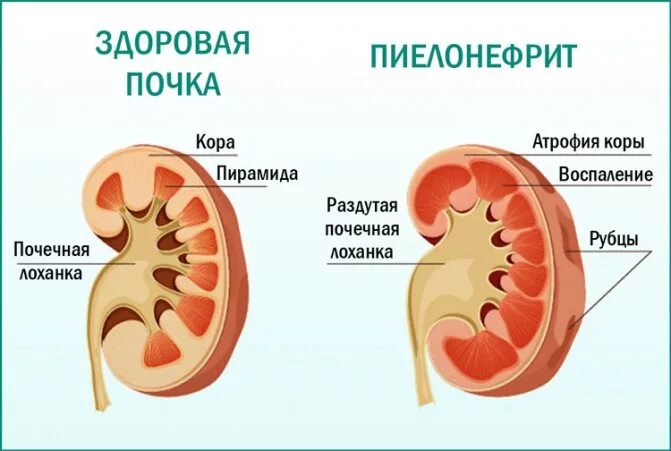 Воспаление почечной лоханки. Уросептики при пиелонефрите почек. Пиелит это