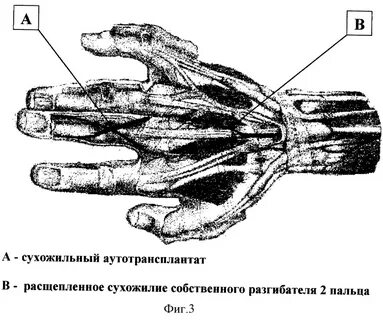 Повреждение сухожилий кисти