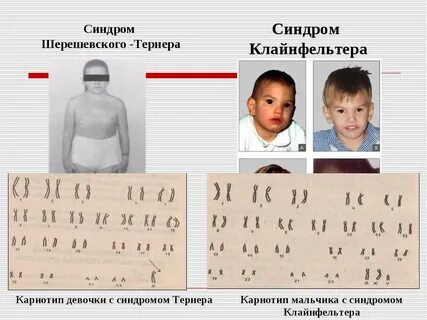 Шерешевского тернера причины