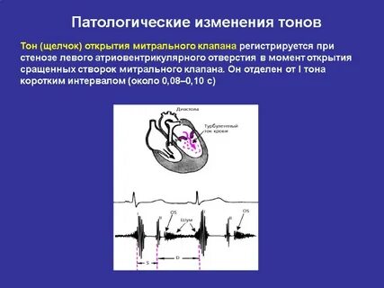 Шум открытия митрального клапана