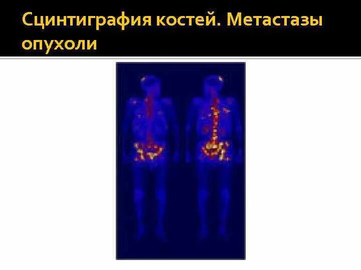 Метастазы скелета. Сцинтиграфия скелета метастазы. сцинтиграфия метастазы в кости. сцинтиграфия на костные метастазы. сцинтиграфия костей метастазы рмж.
