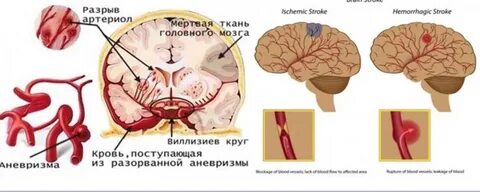 Недостаточное кровоснабжение мозга