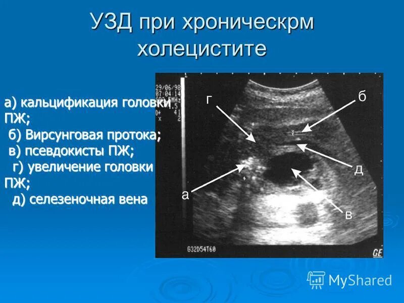 Хронический холецистит отзывы