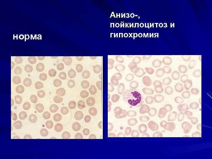 Гипохромия эритроцитов