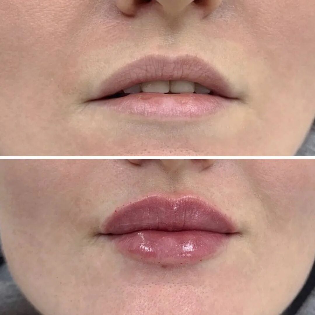 Как правильно разминать губы после. Увеличение губ Juvederm Ultra 3.