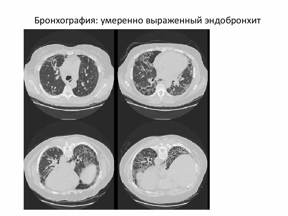 Диффузный эндобронхит. Диффузный катаральный эндобронхит. диффузный гнойный эндобронхит.