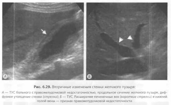 Диффузное утолщение стенок. Утолщение стенки желчного пузыря на УЗИ. Изменения стенки желчного пузыря на УЗИ. УЗИ утолщение стенок желчного. Отек стенки желчного пузыря на УЗИ.