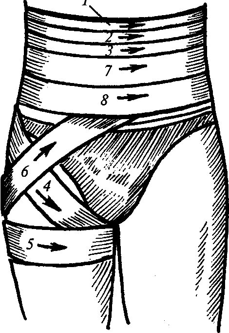 Бедренная перевязка. Техника наложения спиралевидной повязки на живот. Бинтовые повязки на живот циркулярная. Циркулярная повязка колосовидная. Спиральные колосовидные и крестообразные повязки.