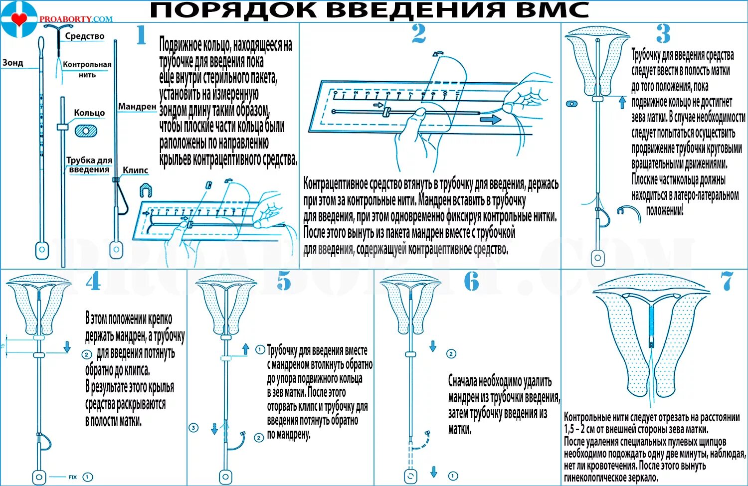 Спираль внутриматочная схема установки. Введение внутриматочной спирали алгоритм. Алгоритм введения внутриматочного контрацептива. Введение ВМС алгоритм.