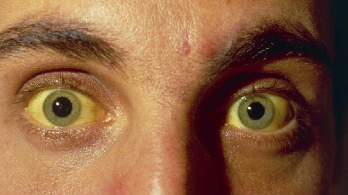 Гемолитическая желтуха болезнь Боткина. Иктеричность кожных склер.