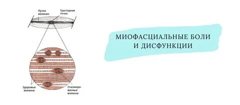 Миофасциальные дисфункции