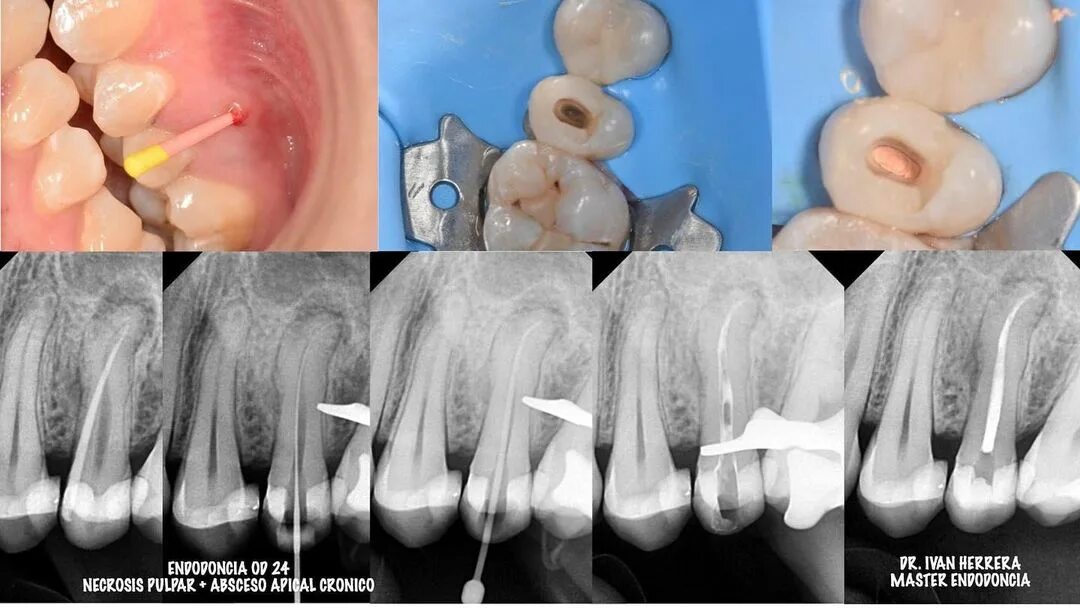 Cuanto cuesta endodoncia