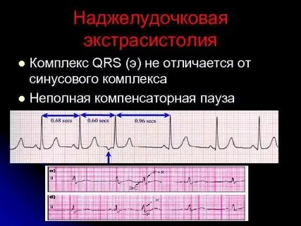 Экстрасистолия опасна для жизни
