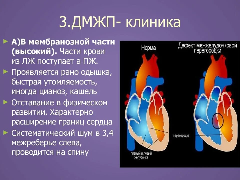 Впс дмжп у детей. ) дефект межжелудочковой перегородки сердца врожденный. мембранозная часть межжелудочковой перегородки сердца. порок сердца дефект межжелудочковой перегородки. врожденные пороки сердца дефект межжелудочковой перегородки(дмжп).