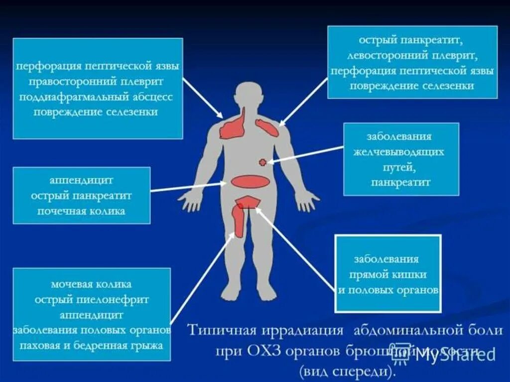 Абдоминальная боль. Локализация боли в брюшной полости. Травмы органов брюшной полости. Острая абдоминальная боль. Заболевания локализация боли