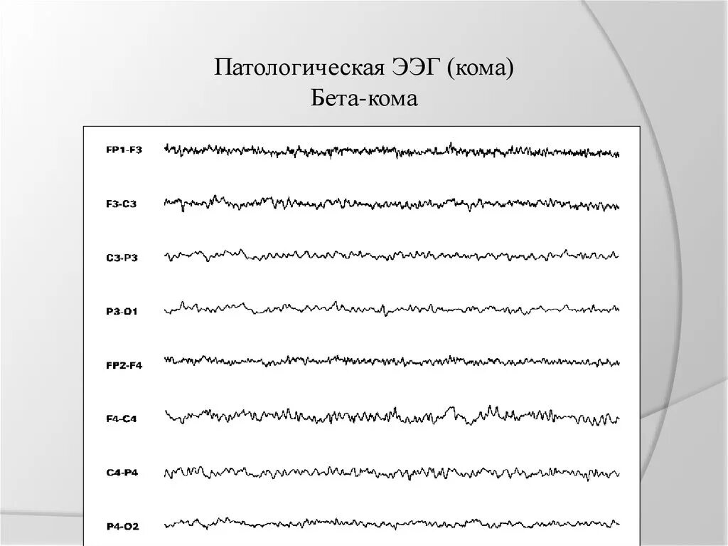Чем отличается ээг от. Бета кома на ЭЭГ. Дельта кома на ЭЭГ. ЭЭГ при коме 3 степени заключение. Кома 1 на ЭЭГ.