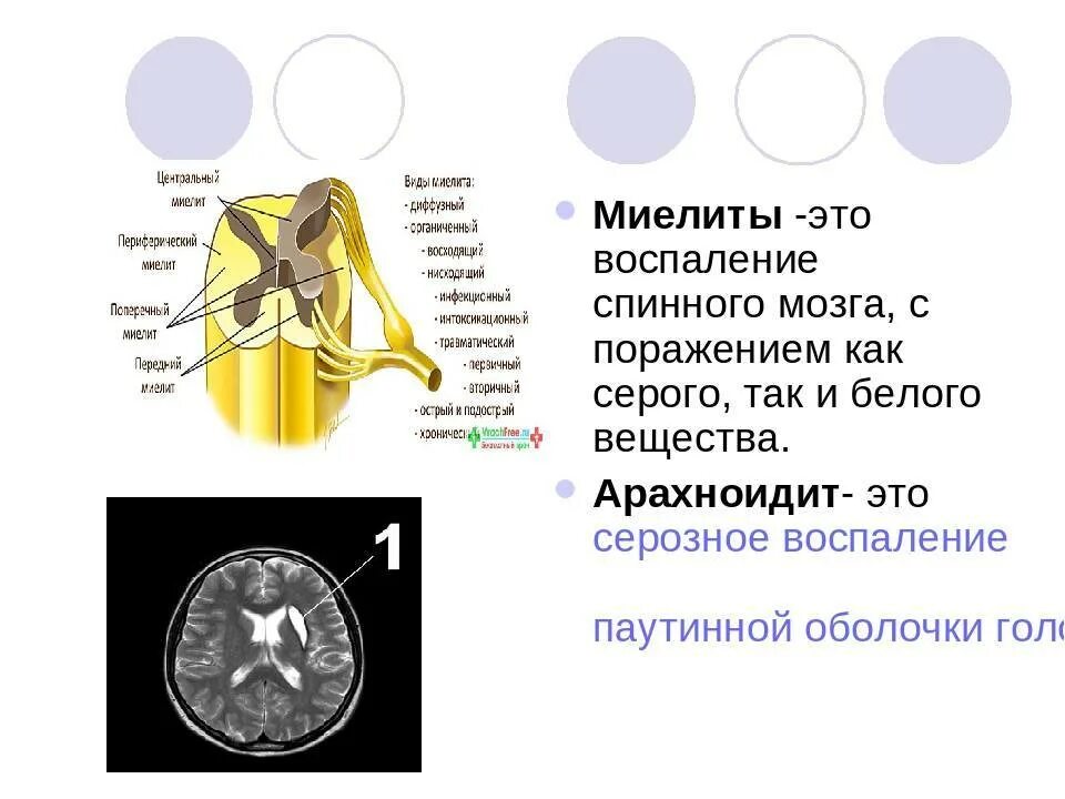 Воспаление оболочек головного и спинного мозга. Поперечный миелит. острый инфекционный поперечный миелит. синдромы острого инфекционного миелита. острый поперечный миелит спинного мозга.