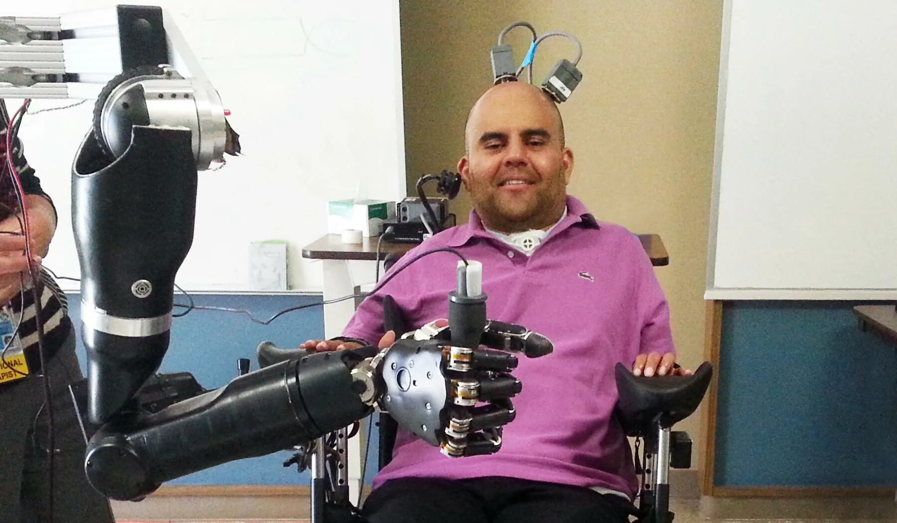 Протез кисти в fusion 360. Управляемый протез руки. Bebionic 3. Джесси салливан бионические протезы. Нейропротезы бионика.