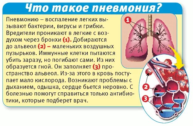 Пневмония процесс заболевания. Воспалительный процесс в легких.