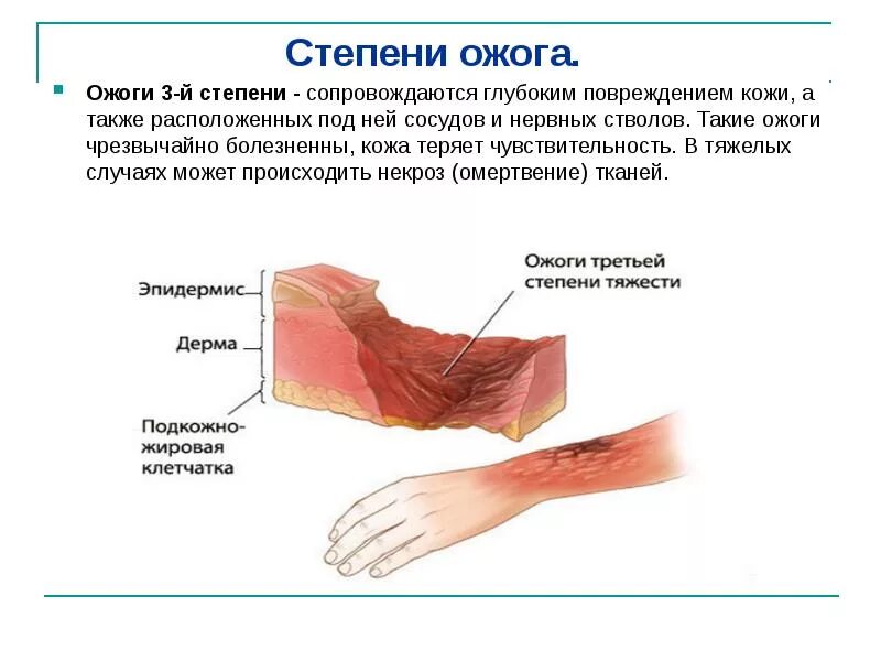 Крайне болезненно. Ожог 1 степени и 2 степени. Характеристика ожогов 2 степени. Ожог четвертой степени характеристика.