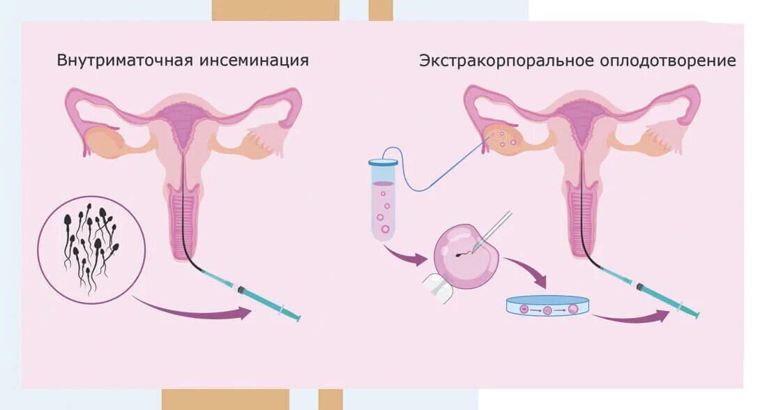 Искусственная внутриматочная инсеминация. Искусственная внутриматочная инсеминация. Внутриматочная инсеминация (вми). Эффективность инсеминация. Искусственной инсеминации.