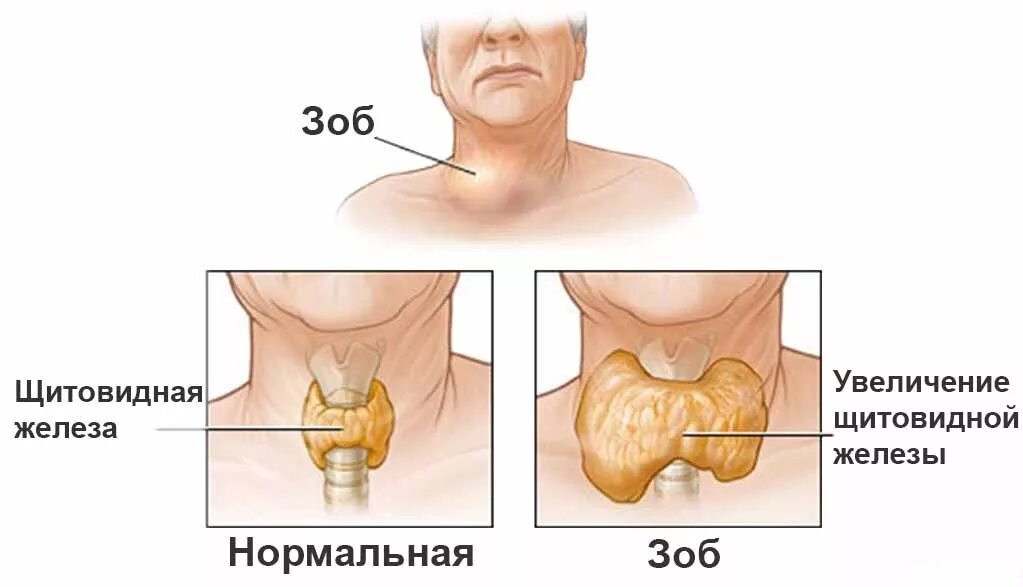 Увеличение заболеваний. Эндемический зоб симптомы. Диффузно Узловой эндемический зоб. Диффузно Узловой зоб диагноз. Профилактика диффузного токсического зоба.