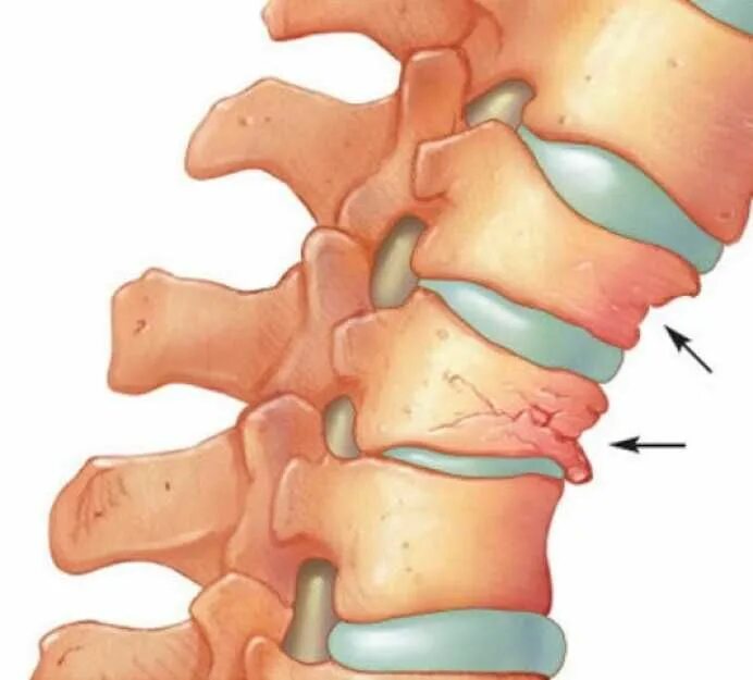 Повреждения позвоночника переломы. Компрессионный перелом шейного отдела позвоночника. Перелом остистого отростка th10. Хлыстовой перелом позвоночника. Хлыстообразный перелом шейного отдела.