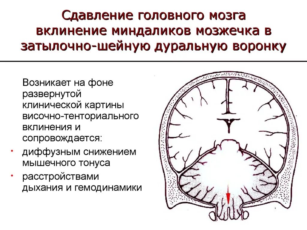 Дислокация срединных структур головного мозга кт. Вклинивание ствола мозга симптомы. Механизм дислокации и вклинения головного мозга. Вклинение ствола головного мозга кт. Диффузный характер головного мозга